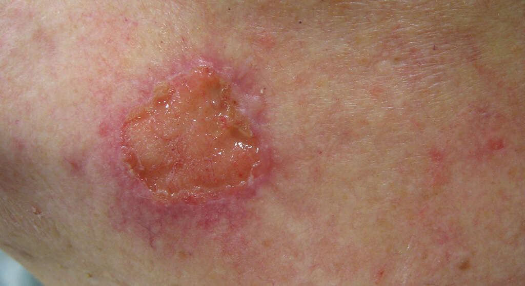 Squamous Cell Carcinoma