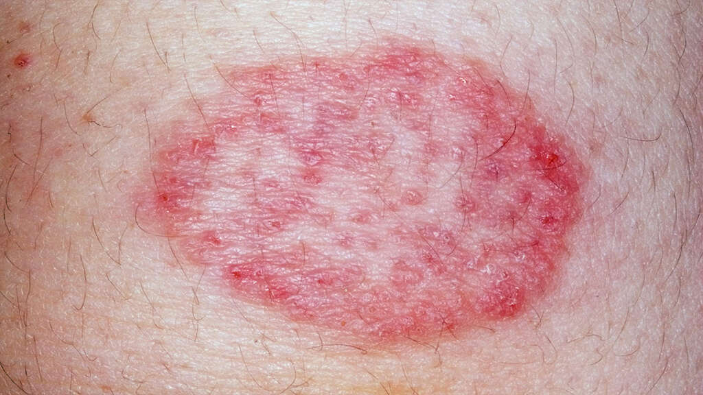 Squamous Cell Carcinoma