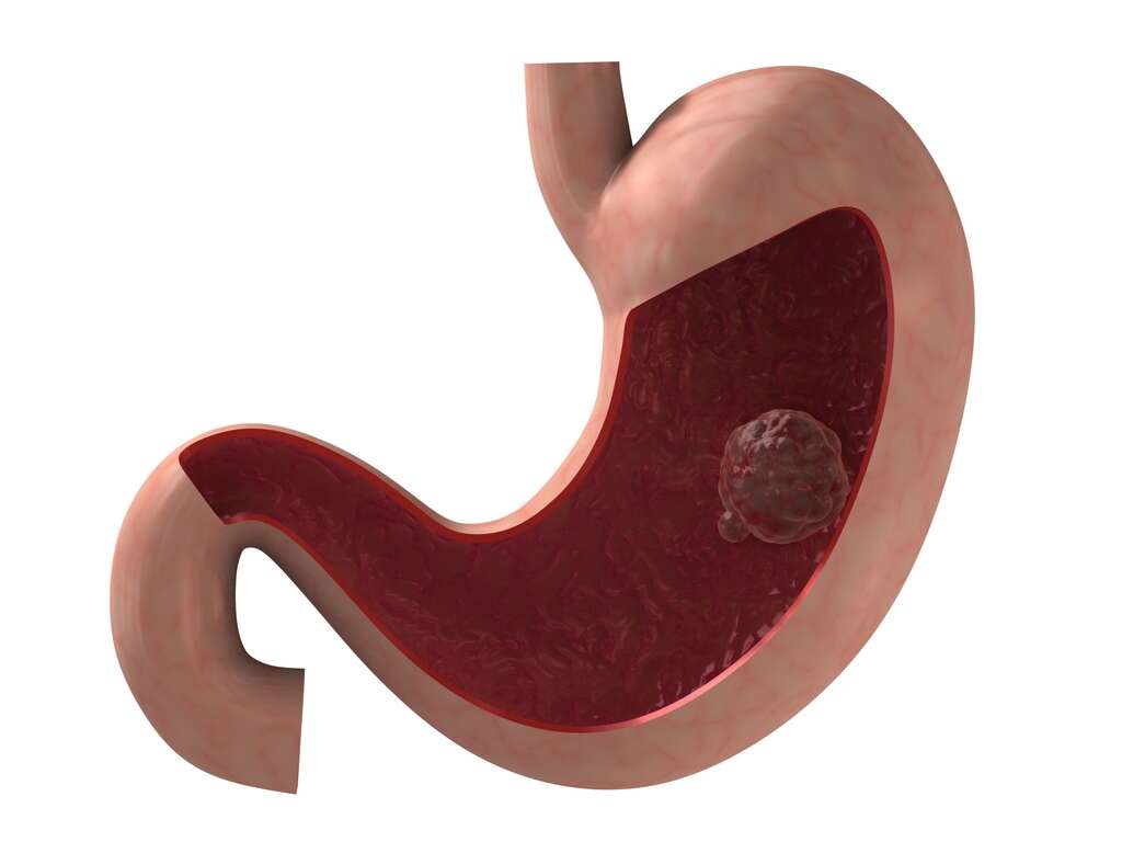 Stomach Cancer