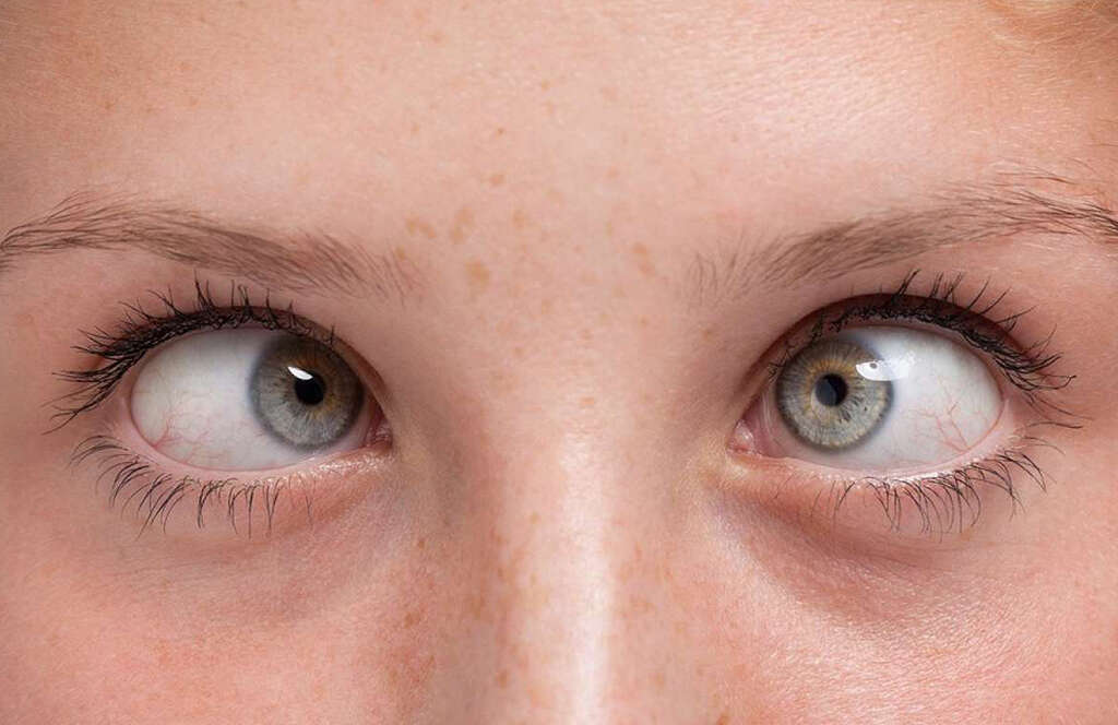 Strabismus