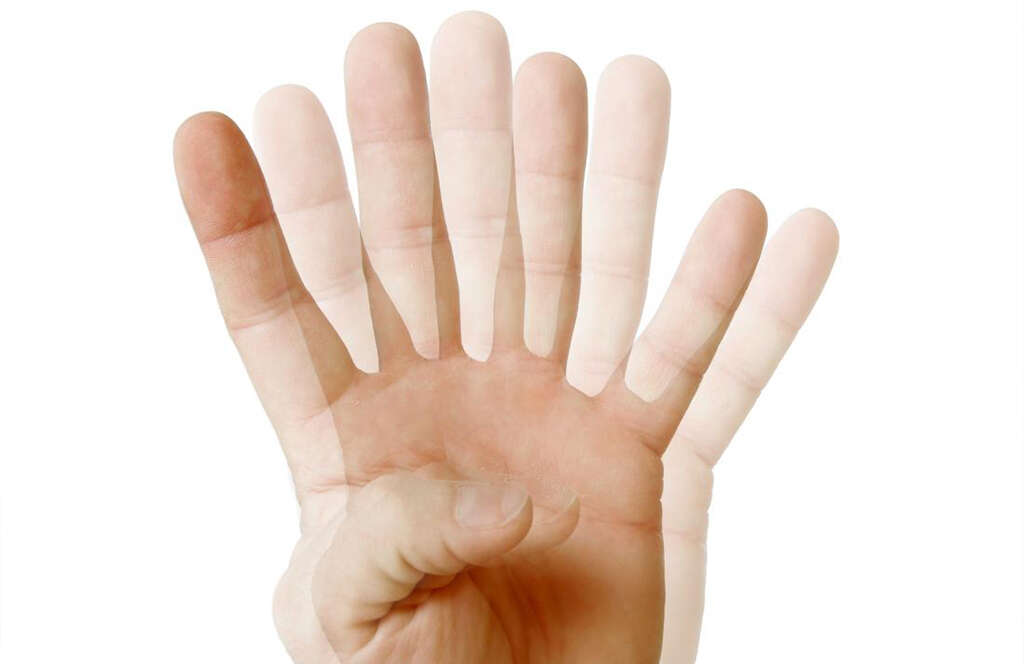 Strabismus
