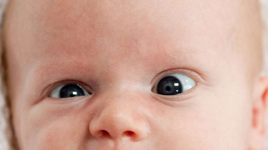 Strabismus