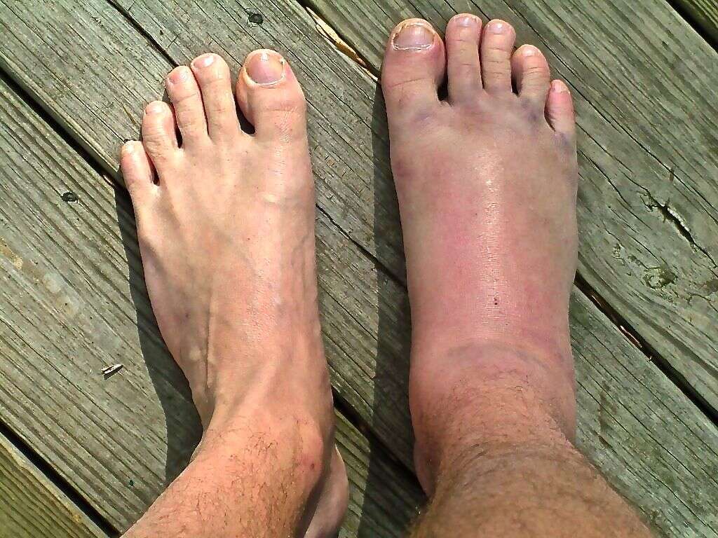 Swollen Ankles