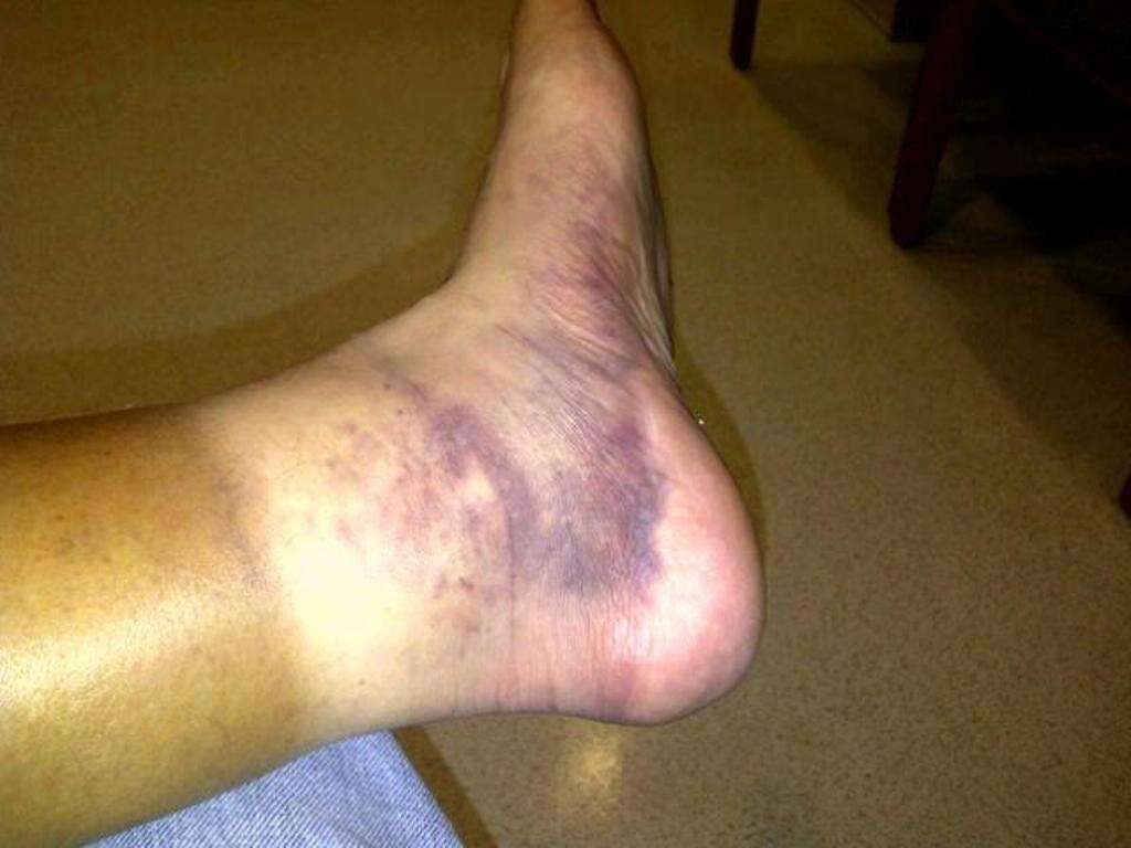 Swollen Ankles