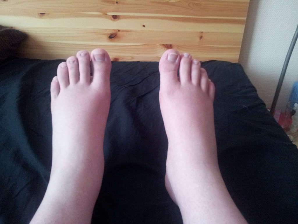 Swollen Ankles