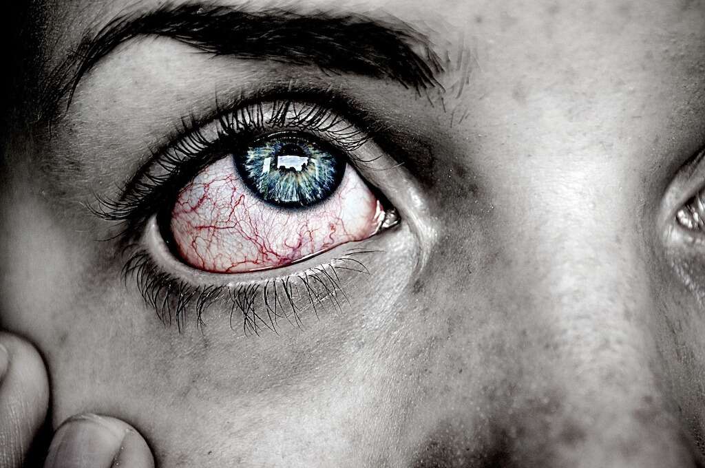 Swollen Eyes