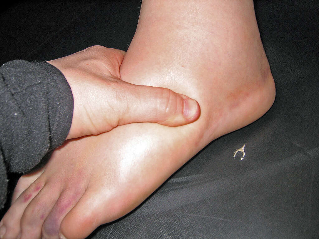 Swollen Feet