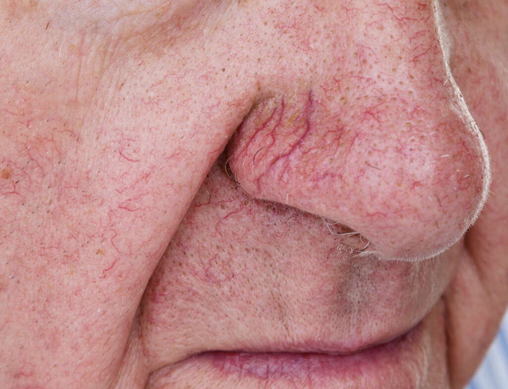 Ataxia