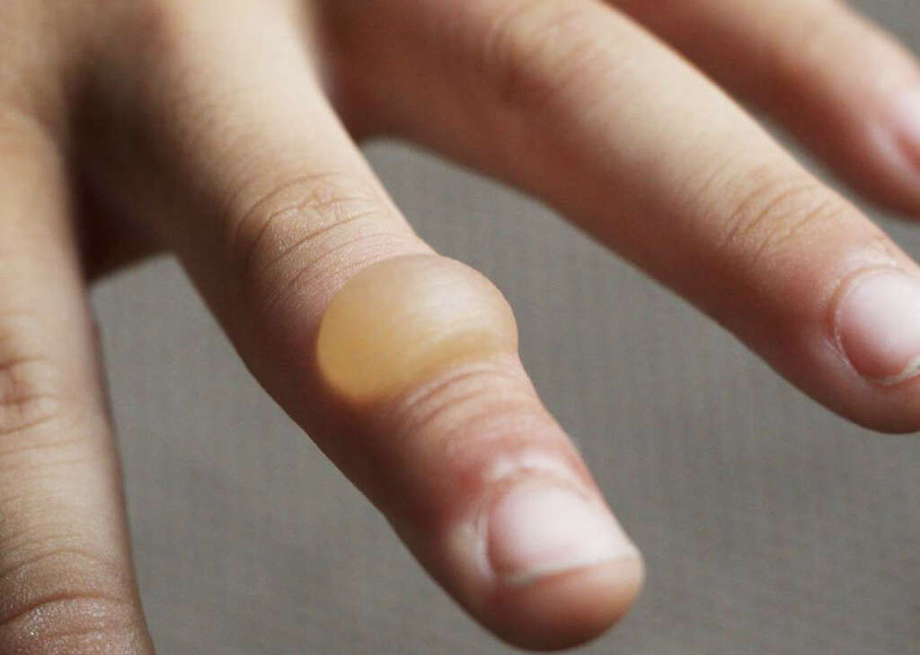 Chilblains