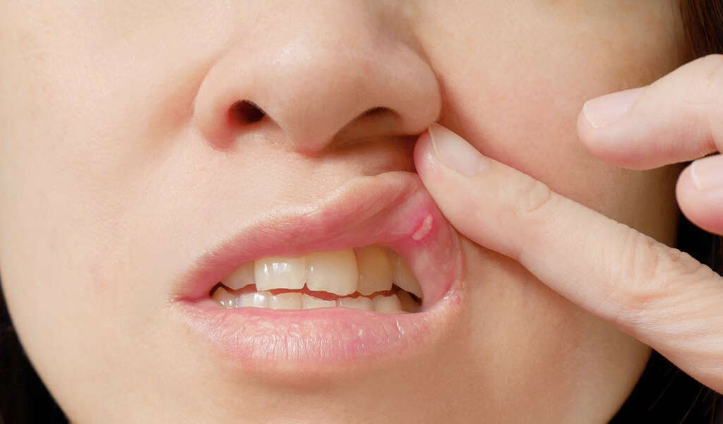 Chilblains