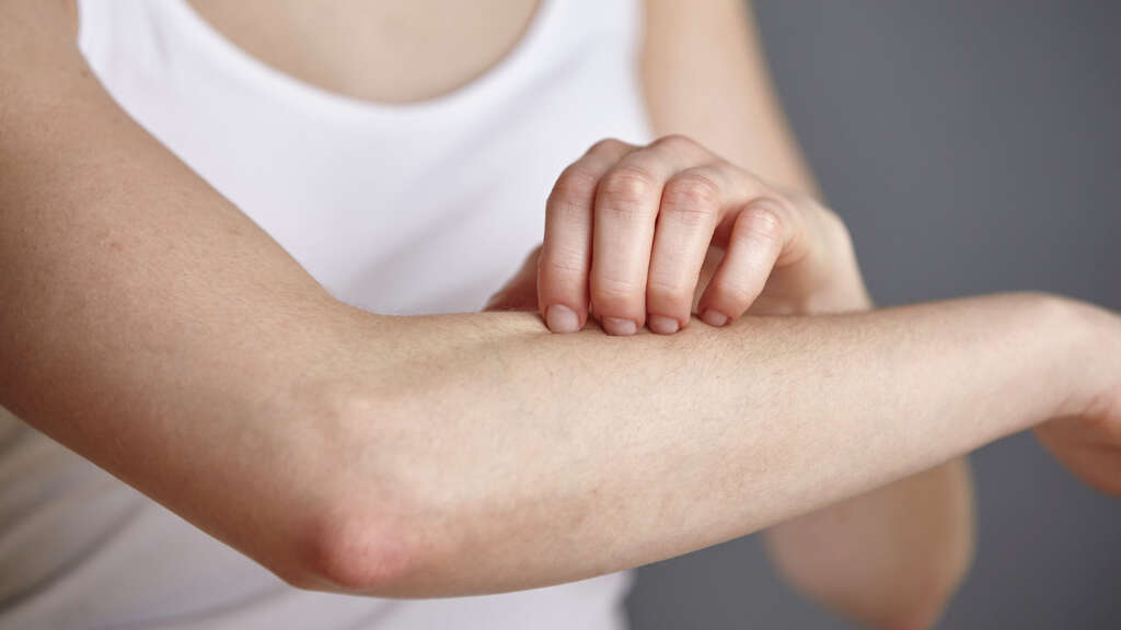 Chilblains