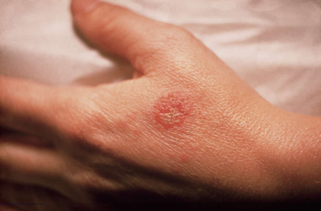 Discoid Eczema