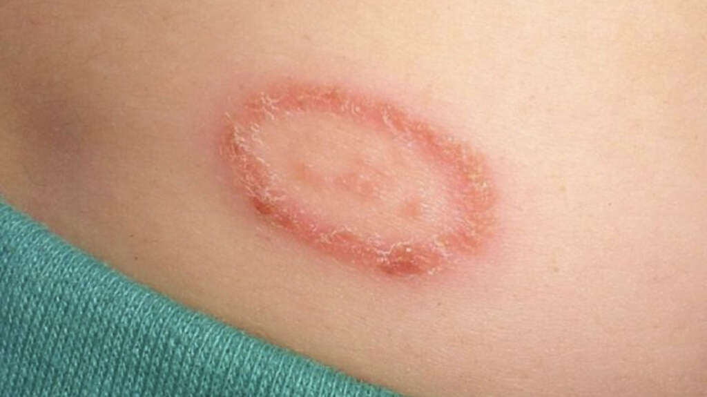 Discoid Eczema