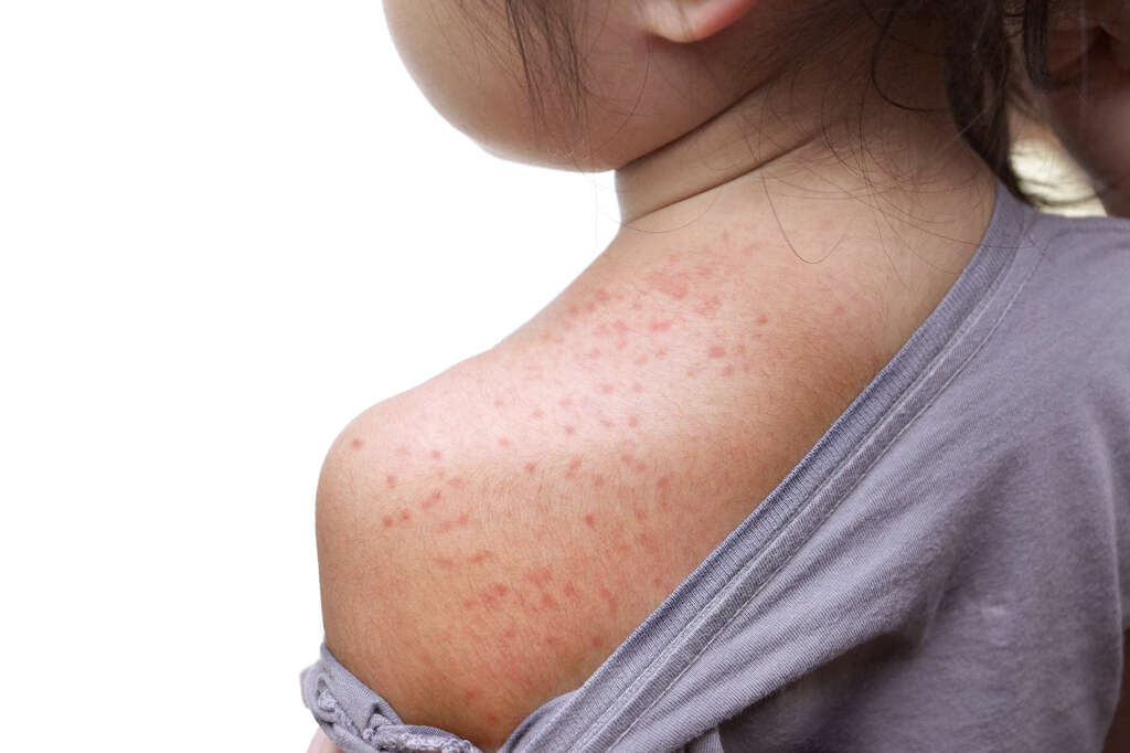 Discoid Eczema