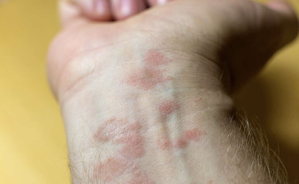 Discoid Eczema