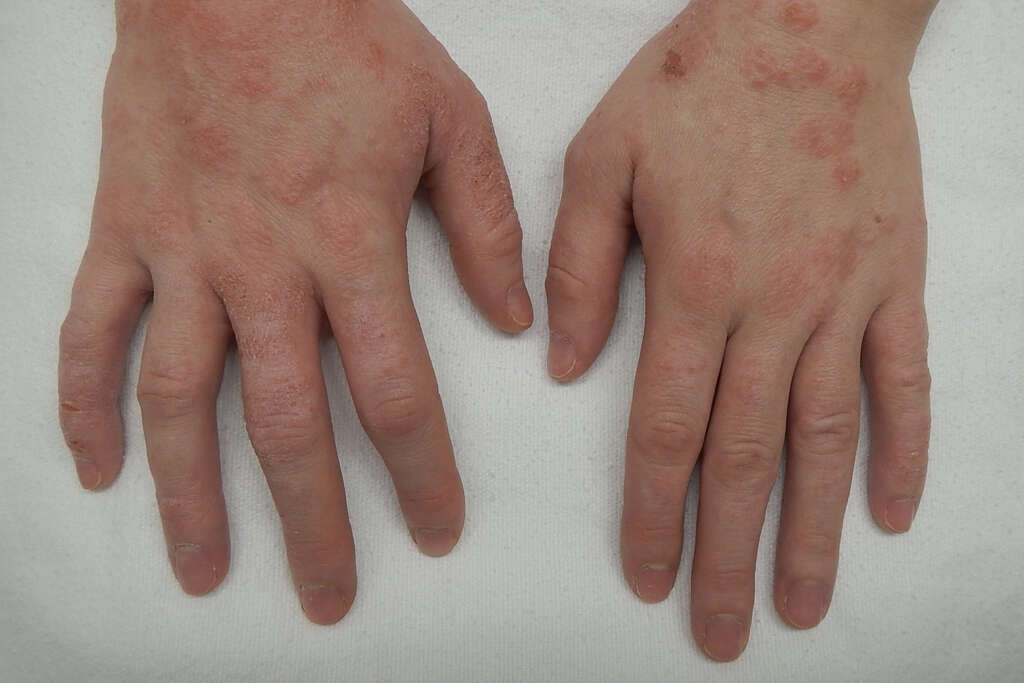 Discoid Eczema