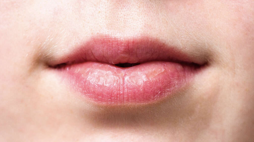 Dry Mouth