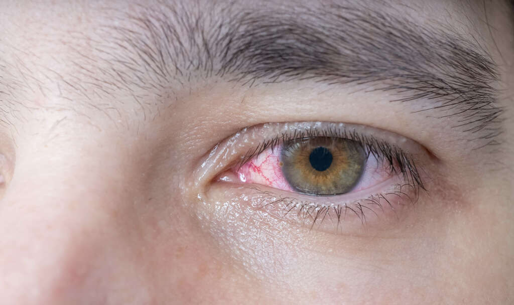 Eye Cancer
