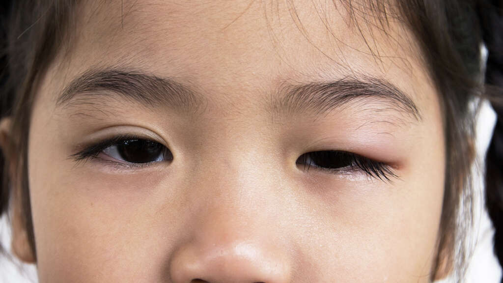 Eye Cancer