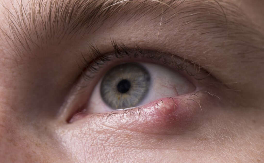 Eye Cancer