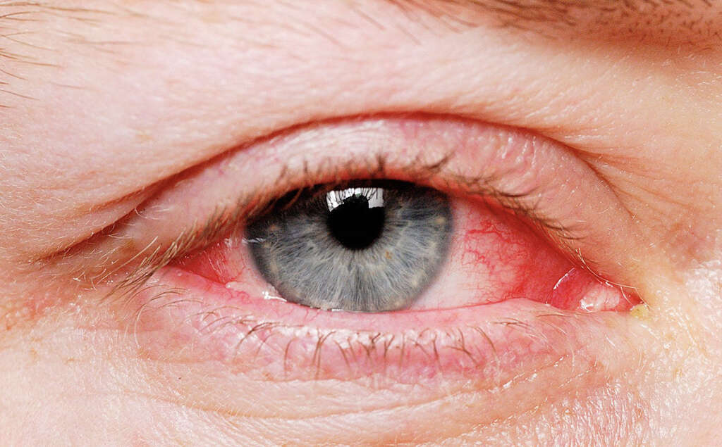 Eye Cancer