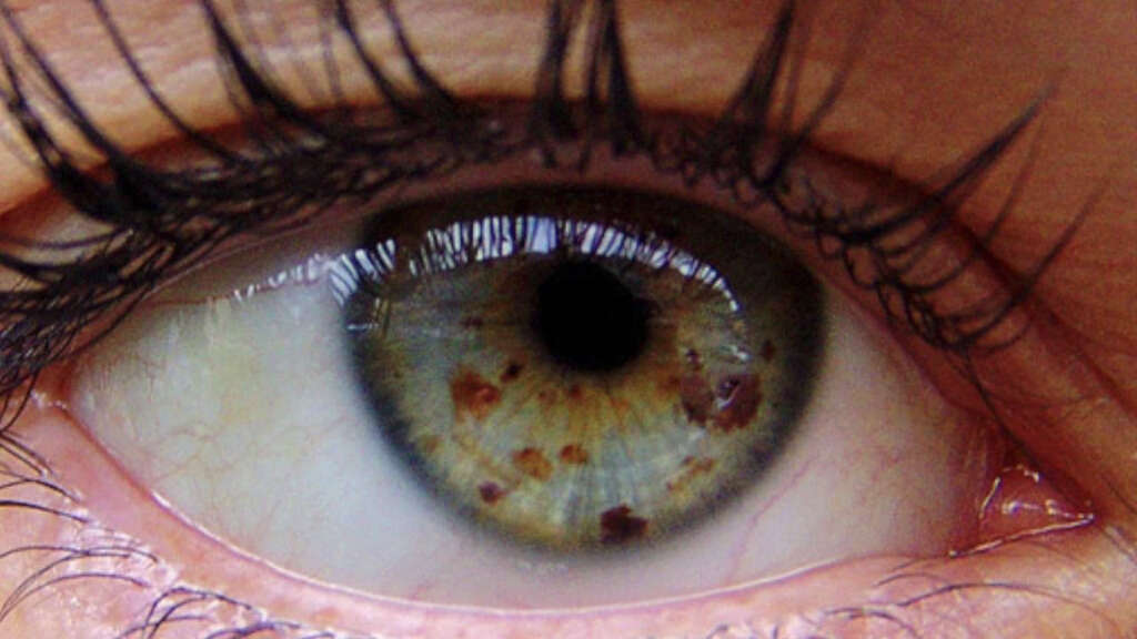 Eye Cancer