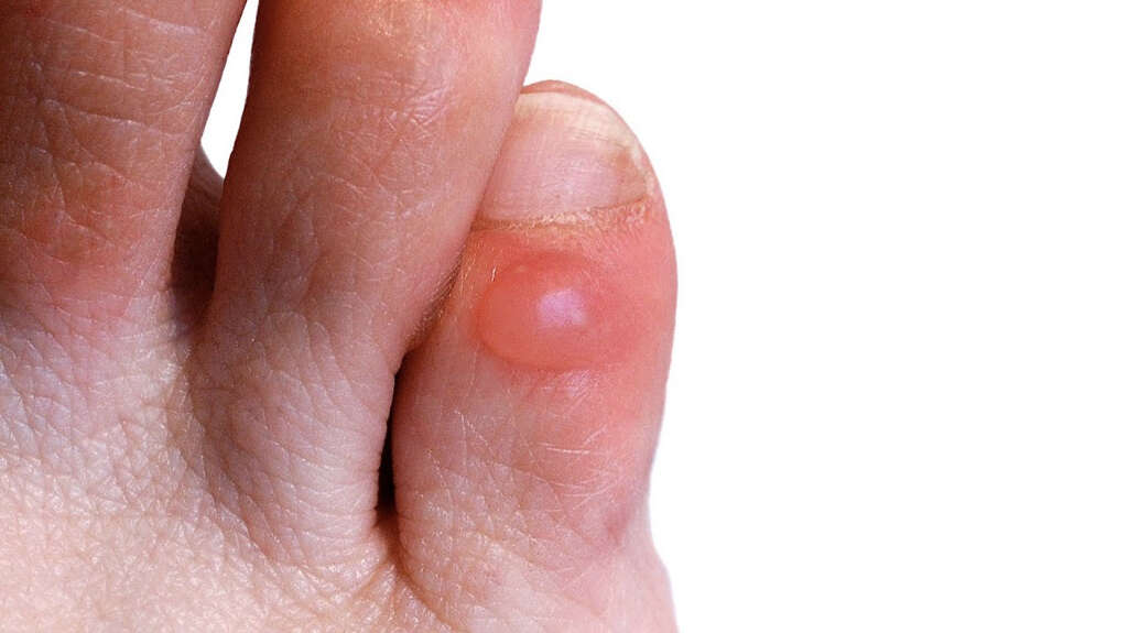 Nummular Dermatitis