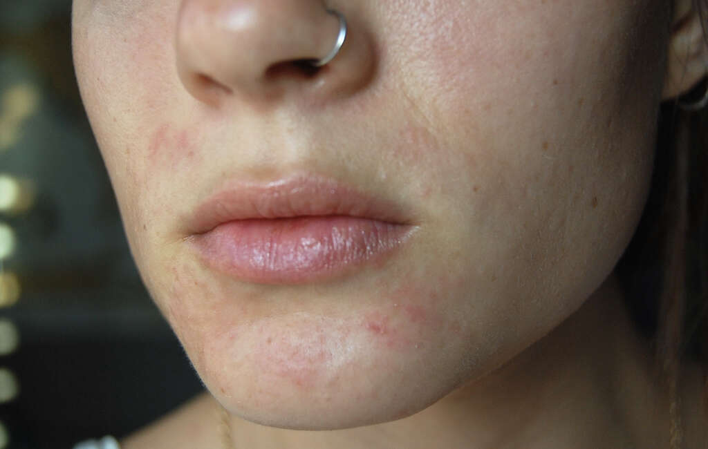 Nummular Dermatitis