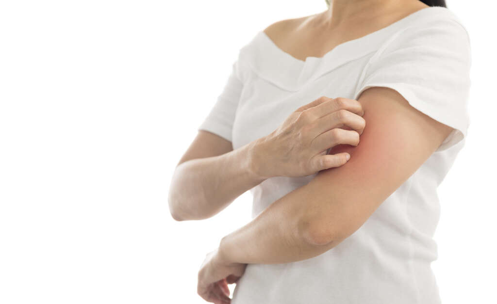 Nummular Dermatitis