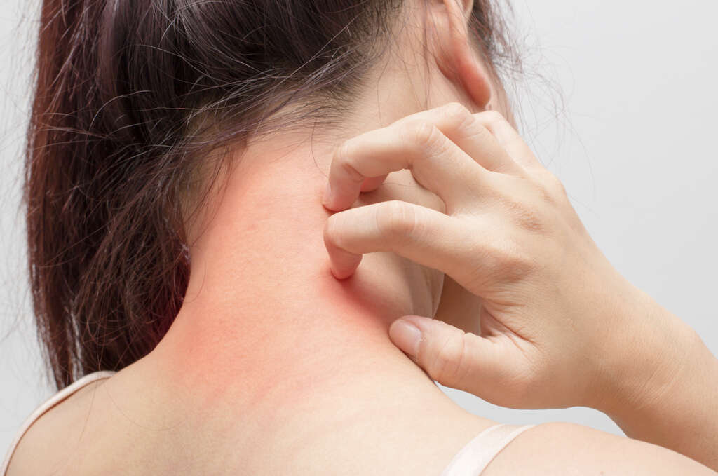 Nummular Dermatitis