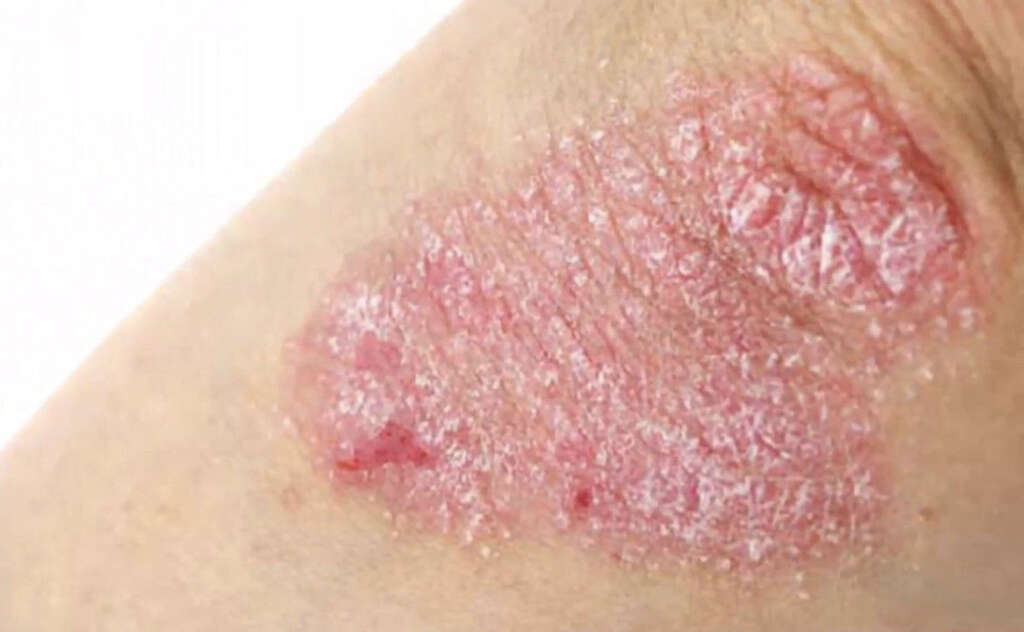 Nummular Eczema