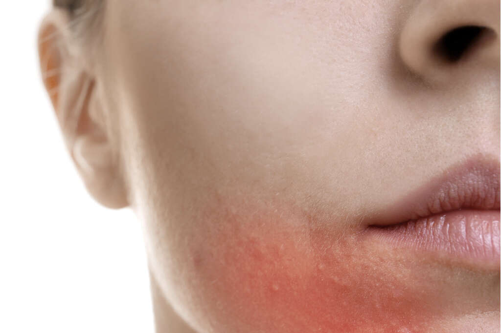 Nummular Eczema