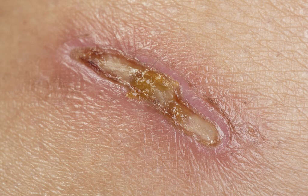 Nummular Eczema