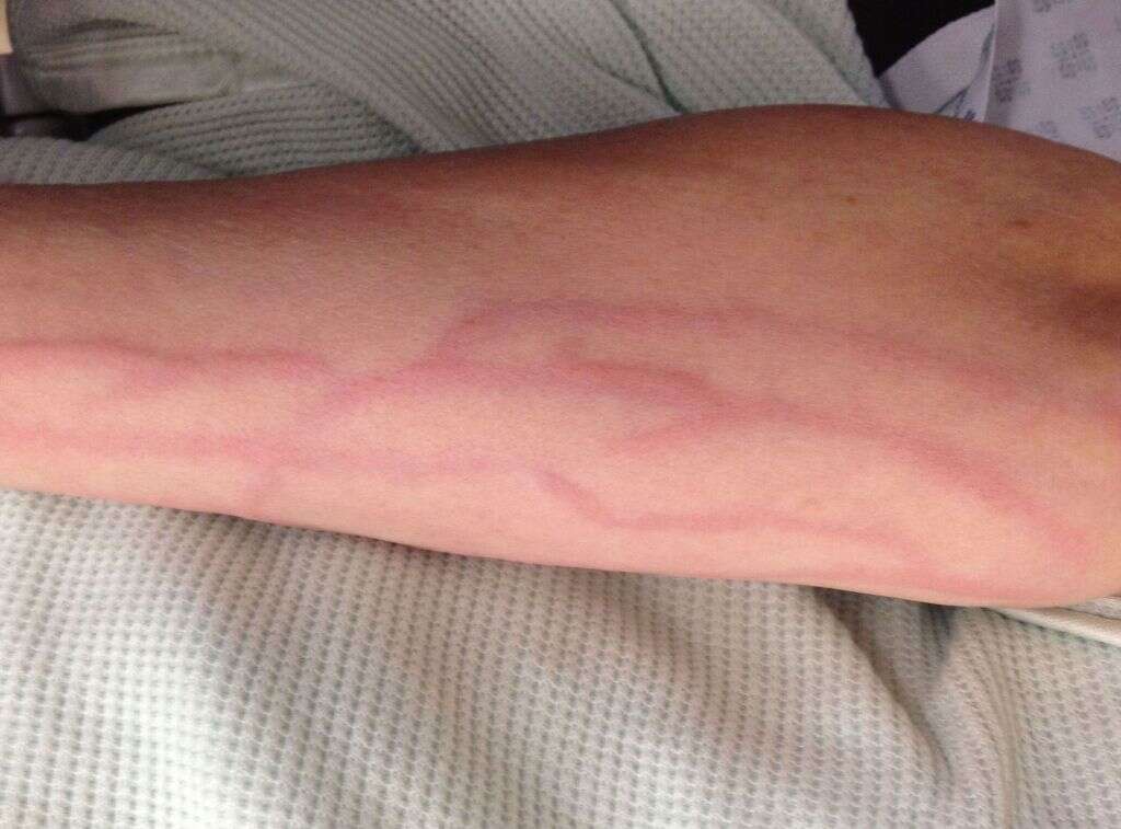 Phlebitis