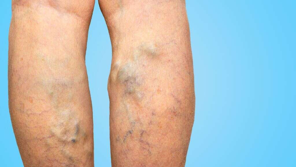 Phlebitis