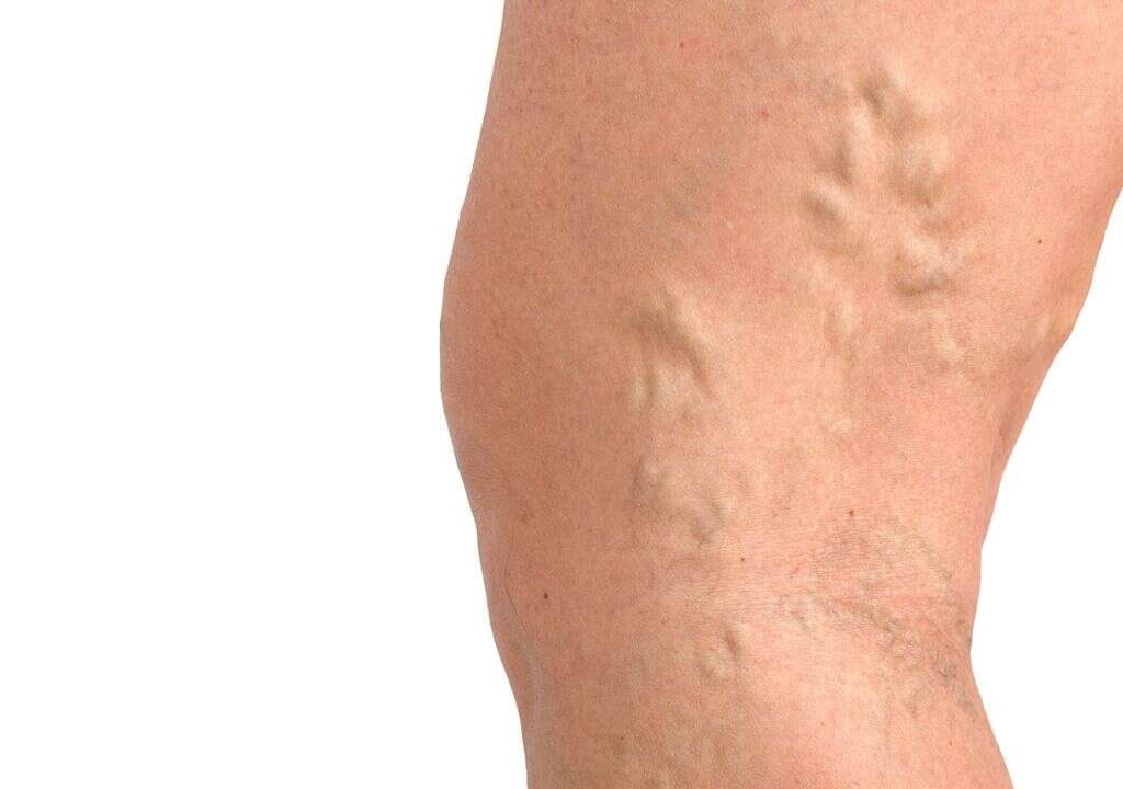 Phlebitis