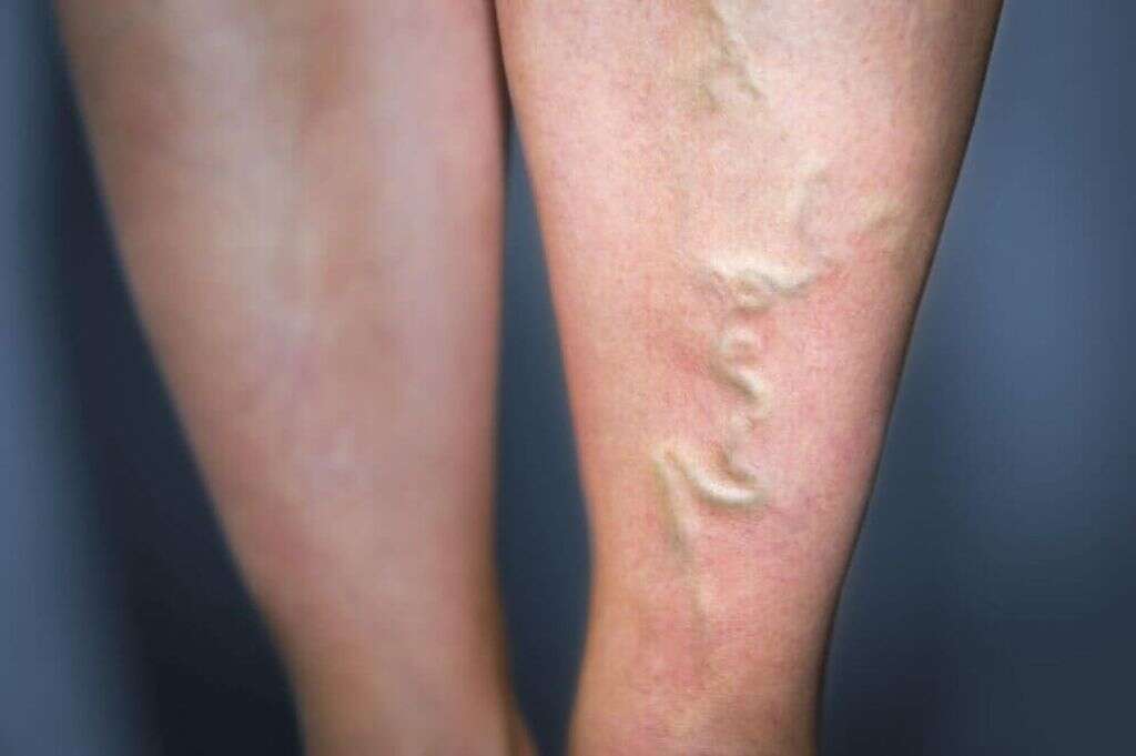 Phlebitis