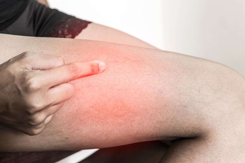 Thrombophlebitis