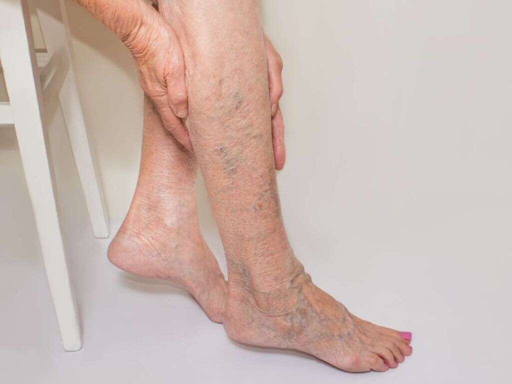 Thrombophlebitis