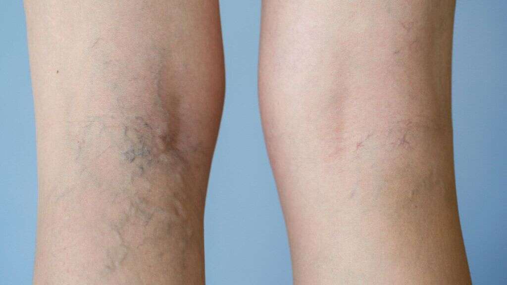 Thrombophlebitis