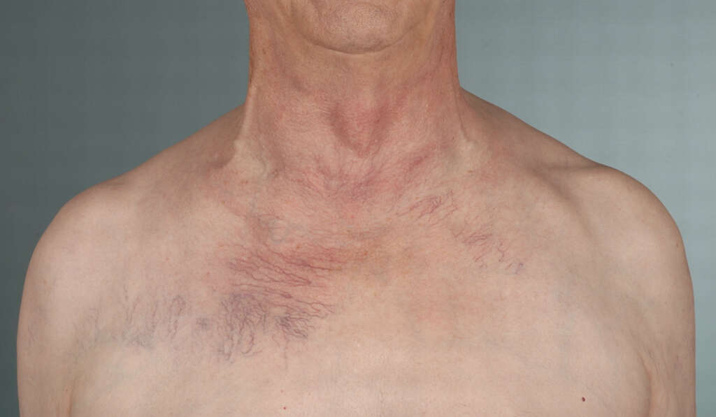 Thoracic Outlet Syndrome