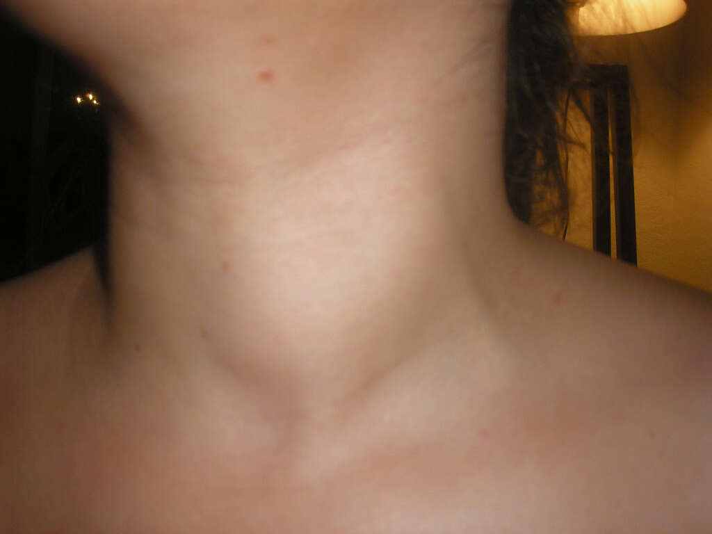 Thyroid Cancer