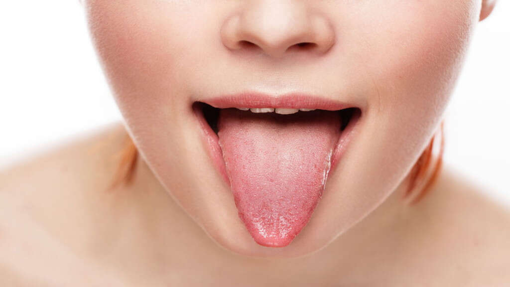 Tongue Cancer