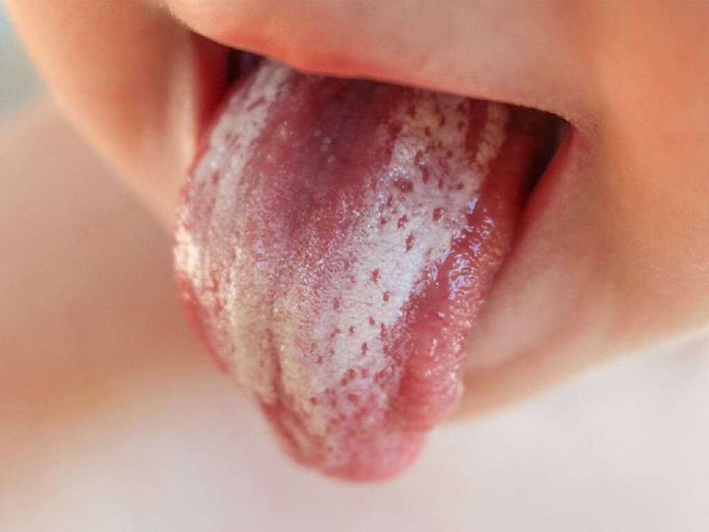 Tongue Cancer