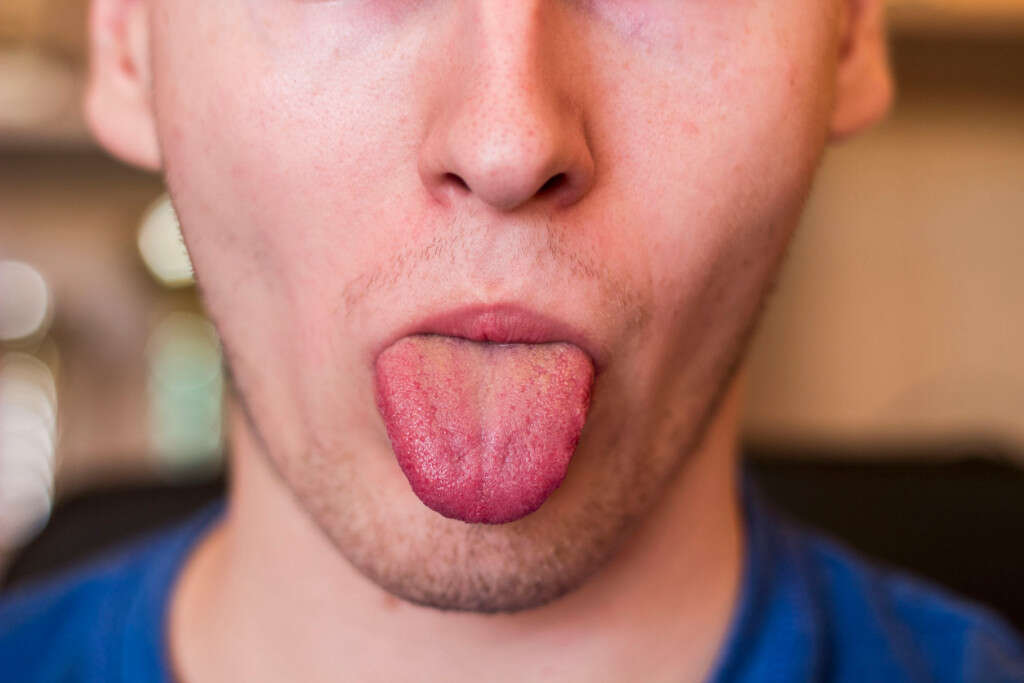 Tongue Cancer