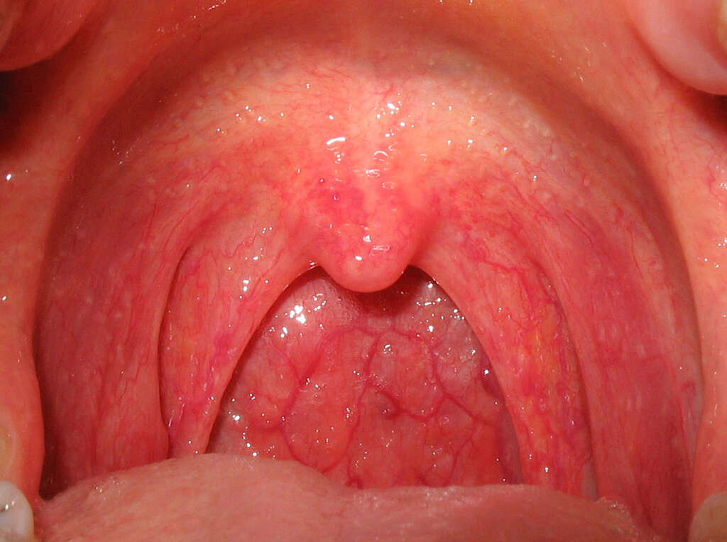 Tonsillitis