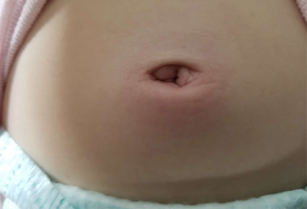 Umbilical Hernia