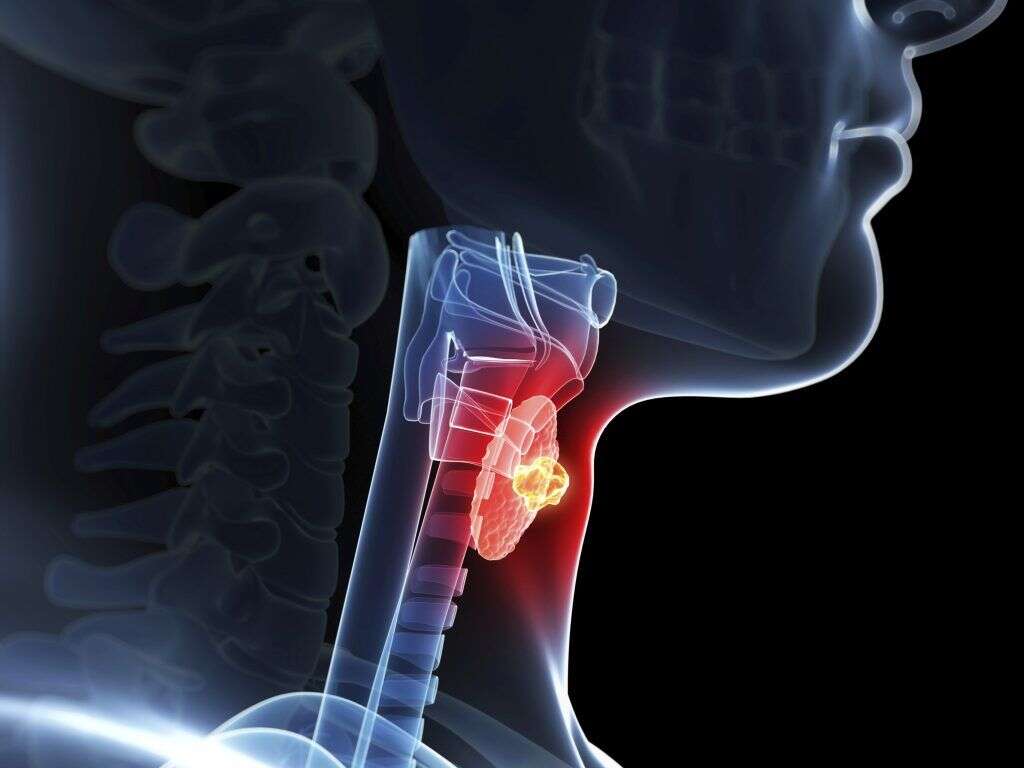 Underactive Thyroid