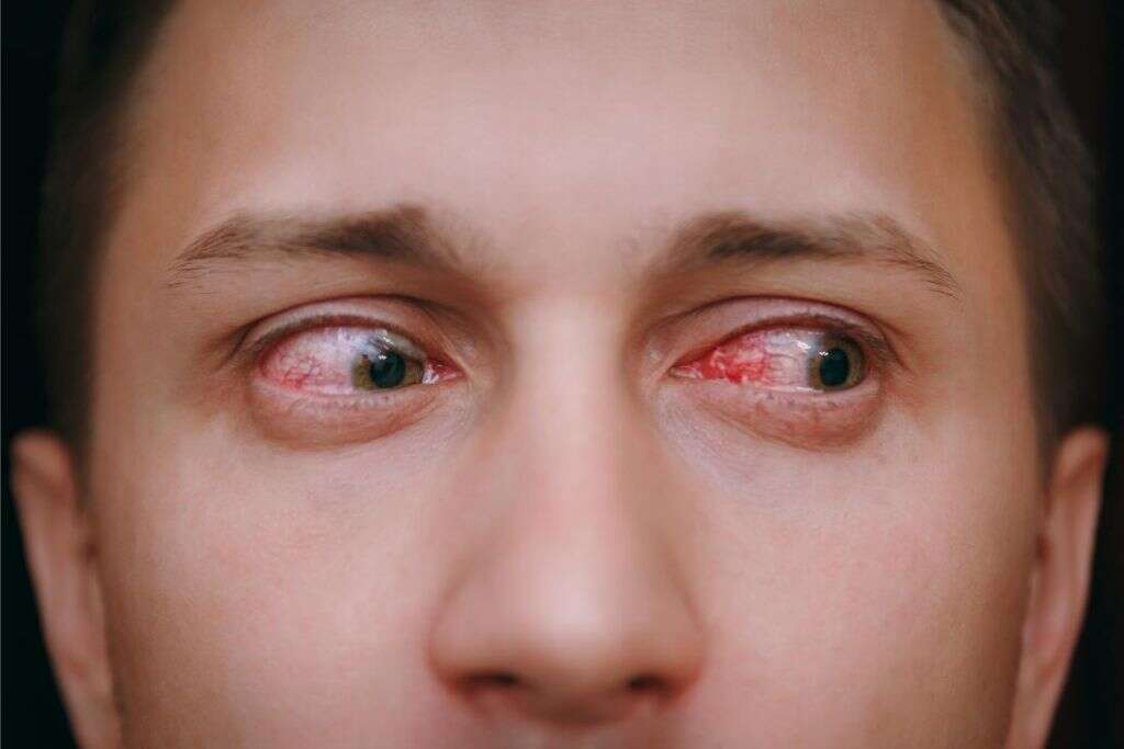 Uveitis