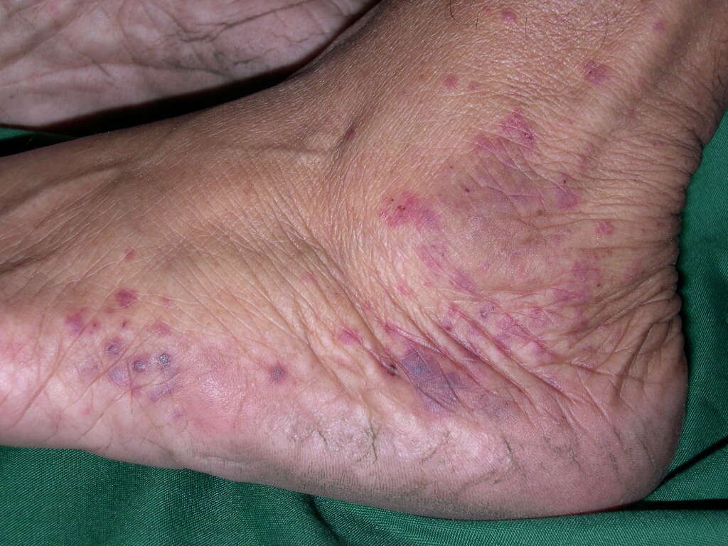 Vasculitis